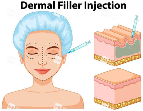 面部填充过程图