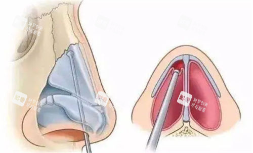 鼻梁鼻尖剖面图 鼻梁鼻尖剖面图