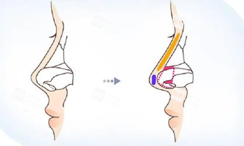 鼻小柱抬高示意图 鼻小柱抬高示意图