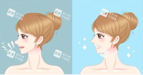 鼻修复对比 鼻修复对比