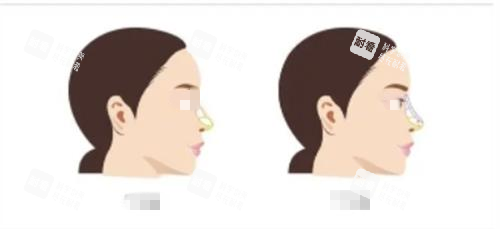 隆鼻前后对比示意图 隆鼻前后对比示意图