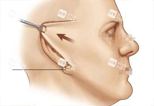 拉皮手术切口展示