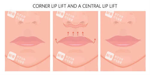 人中缩短手术动画图示 人中缩短手术动画图示
