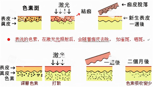 激光祛斑过程