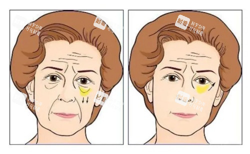 胶原蛋白去泪沟术后对比示意图