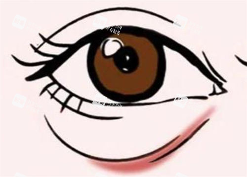 轻度泪沟动画展示图