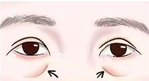 眼部泪沟标注动画展示图