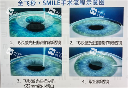 临沂华厦眼科全飞秒手术过程图解