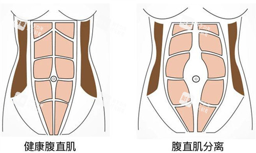 腹壁成形术前后腹直肌的变化图解