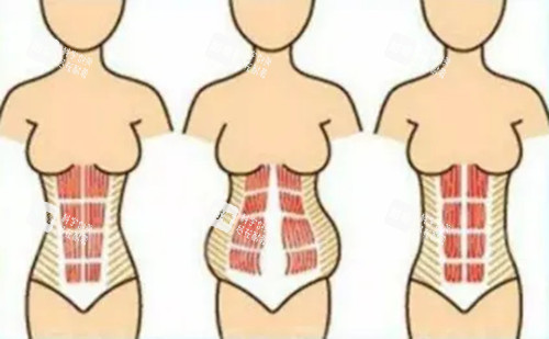 腹壁成形手术卡通示意图