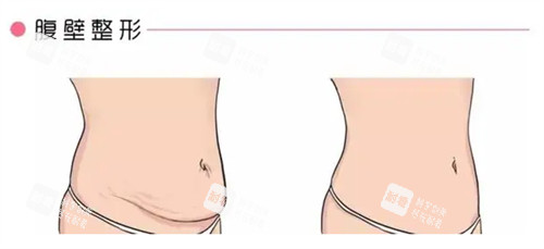 腹壁成形术前后对比图