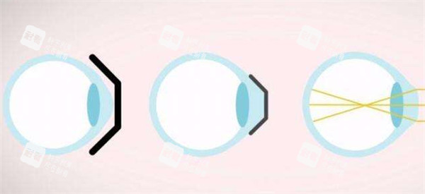 近视矫正过程中眼球的变化图解 近视矫正过程中眼球的变化图解