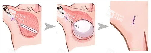假体隆胸术图 假体隆胸术图