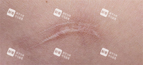 增生的疤痕 增生的疤痕