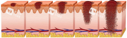 不同深度的疤痕 不同深度的疤痕