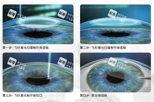 全飞秒手术图 全飞秒手术图