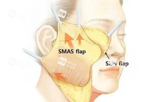 面部拉皮卡通示意图