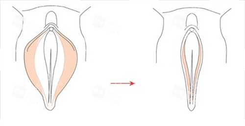 女性私密手术外阴动画展示
