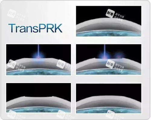 TPRK近视手术示意图 TPRK近视手术示意图