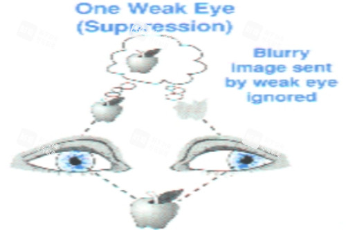 弱视视物示意图