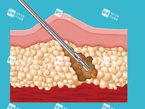 吸脂针图片
