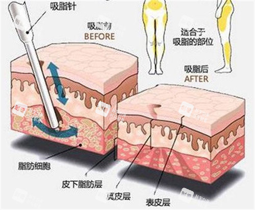 吸脂原理示意图