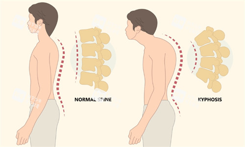 富贵包让人看起来驼背