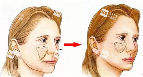 苹果肌下垂术前术后对比动画图