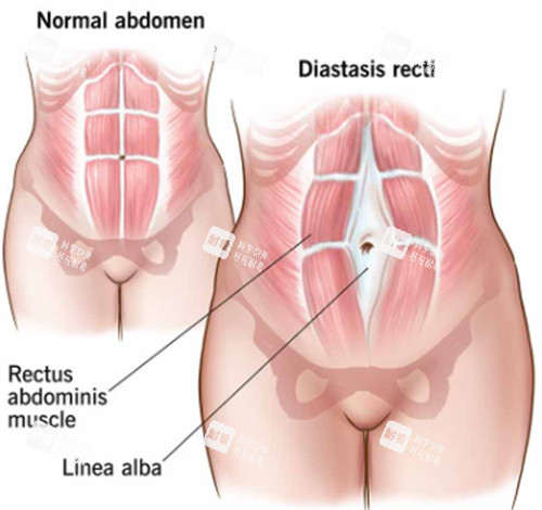腹壁成形手术前后对比