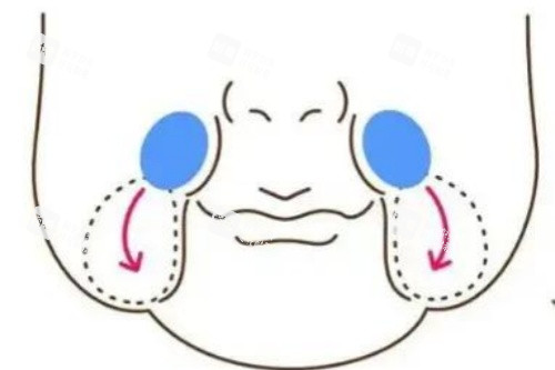 口角囊袋图片展示