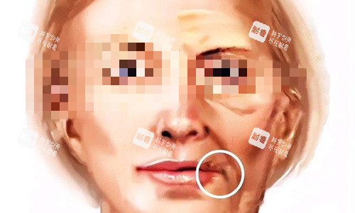 口角囊袋对比图