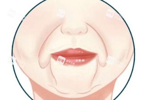 口角囊袋卡通图