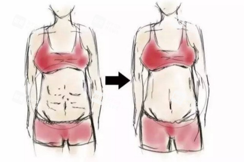 腹壁成型术卡通对比图