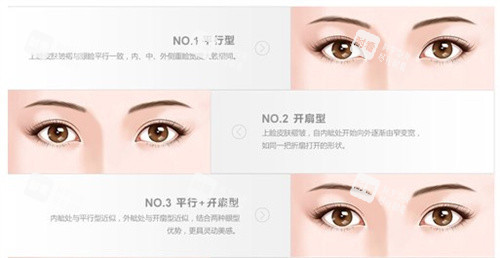 双眼皮的类型 双眼皮的类型