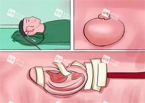 扩张器法耳再造手术演示图 扩张器法耳再造手术演示图