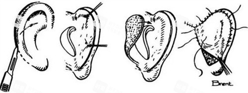 耳再造手术过程 耳再造手术过程