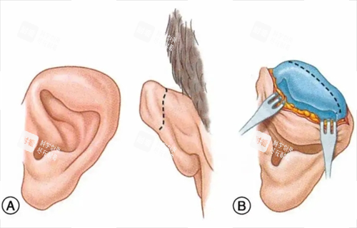 耳再造动画手术过程 耳再造动画手术过程