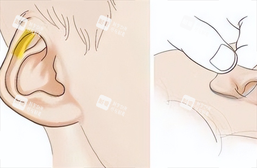 耳再造耳部畸形动画展示 耳再造耳部畸形动画展示