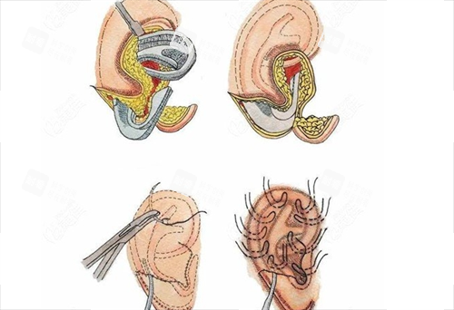 耳再造手术步骤展示 耳再造手术步骤展示