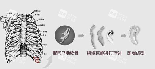 肋软骨耳再造支架.webp 肋软骨耳再造支架.webp