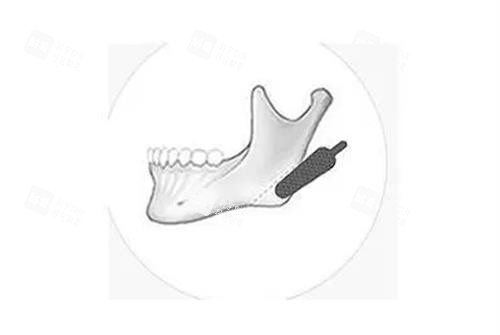 磨骨手术示意图 磨骨手术示意图