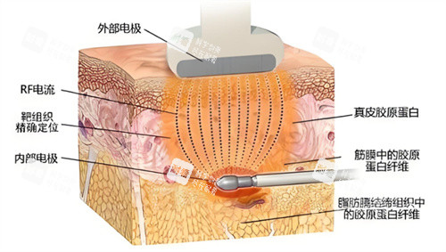 激光溶脂原理图