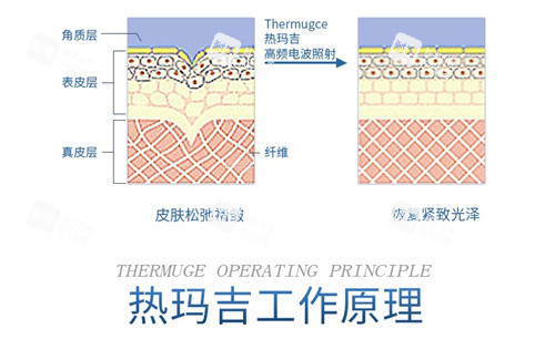 热玛吉工作示意图