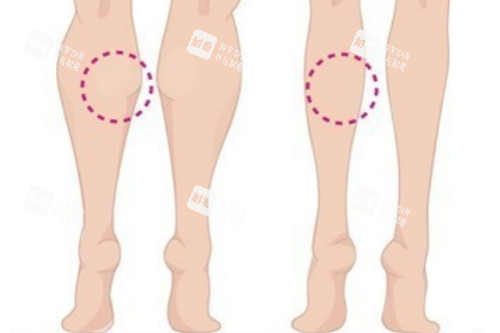 小腿肌肉消除对比图