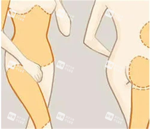 吸脂手术前后对比图