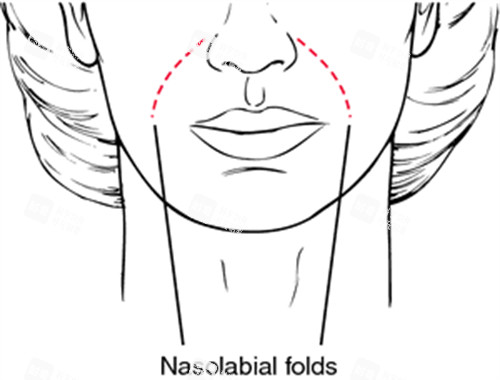 鼻基底凹陷导致法令纹 鼻基底凹陷导致法令纹