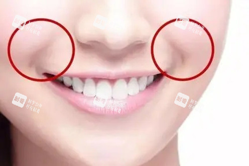 法令纹用什么填充好.webp 法令纹用什么填充好.webp