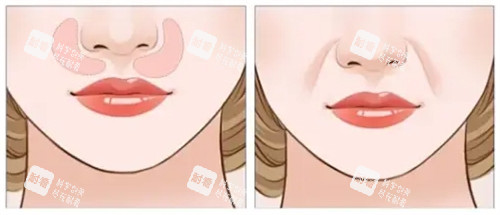 口周老化对面部影响