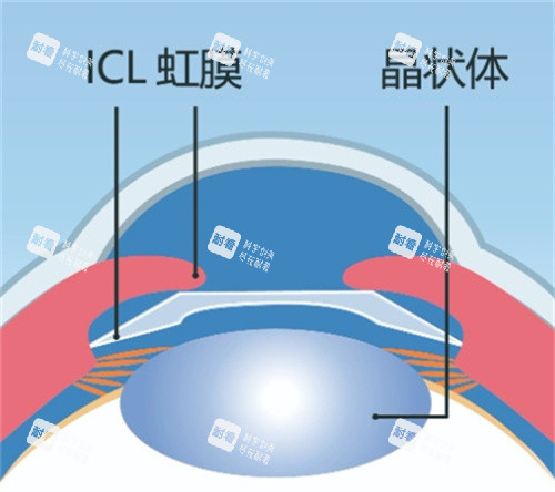 ICL晶体植入结构图片 ICL晶体植入结构图片