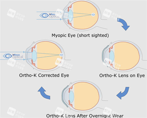 OK镜改善眼表过程